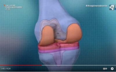 Se implanta la primera prótesis de rodilla personalizada en Aragón
