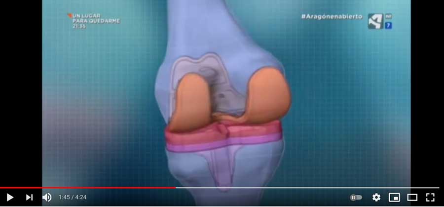 Se implanta la primera prótesis de rodilla personalizada en Aragón